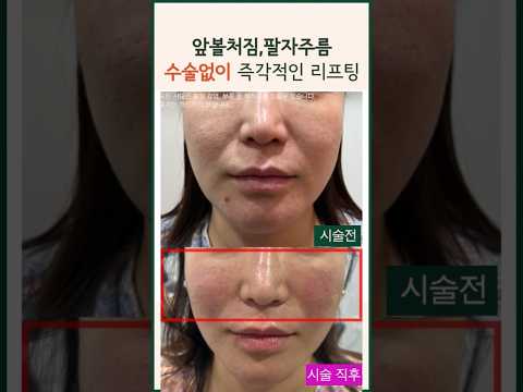 볼 처짐 팔자 주름 얼굴 리프팅 이렇게 변화 가능? | 전후 비교 시술 영상 실리프팅 필러 #앞볼꺼짐 #리프팅 #눈물고랑 #팔자주름 #modsclinic