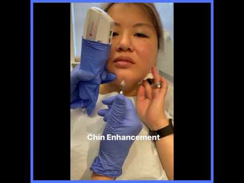 Chin Enhancement I Gendler Dermatology