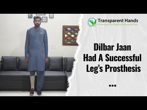 Dilbar Jaan had a Successful Leg’s Prosthesis