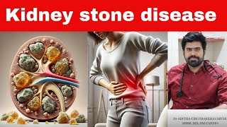 How To Prevent Kidney Stones (5 Tips)