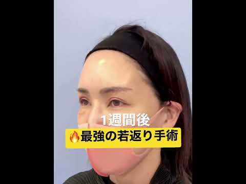 至高の若返り手術＝眉下リフト&脂肪注入