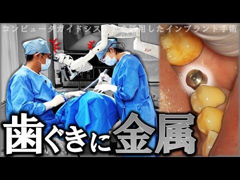 【閲覧注意】歯ぐきに金属…⁉インプラント手術 実際の様子～治療終了まで！#implant　#guidedsurgery