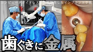 【閲覧注意】歯ぐきに金属…⁉インプラント手術 実際の様子～治療終了まで！#implant　#guidedsurgery