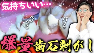 歯茎の中からこんにちは👋🦷大量の隠れ歯石を一網打尽🔥