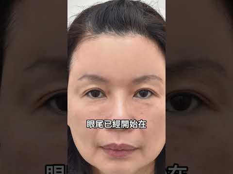 眼皮 #眼尾下垂 #雙眼皮 搞失蹤！ 類戲劇天后林玉紫 新式 #內視鏡上額拉皮 一招挽救 失守 #高髮線 重現迷人電眼