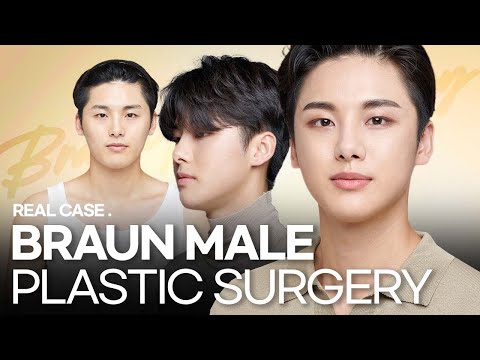 MALE PLASTIC SURGERY BEFORE AND AFTER : BRAUN PLASTIC SURGERY IN KOREA