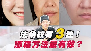 為什麼有法令紋？不是打玻尿酸一定有效！法令紋墊片 法令紋玻尿酸 ｜依心唯美 林子宇醫師