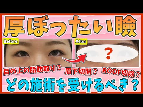 【まぶたの脂肪】厚ぼったい瞼の改善｜眉下切開とまぶたの脂肪取りとROOF切除を比較解説