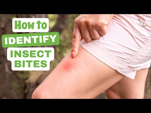 How to Identify Insect Bites: A Comprehensive Guide to Recognizing Common Bug Bites