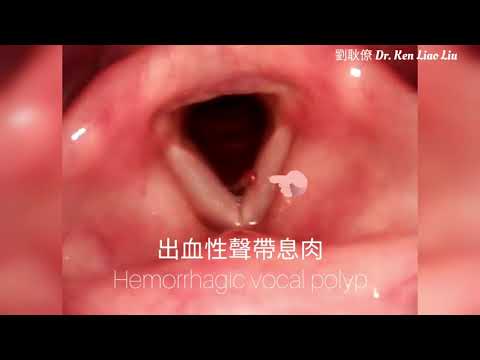 聲音沙啞： 出血性聲帶息肉 hemorrhagic vocal polyp