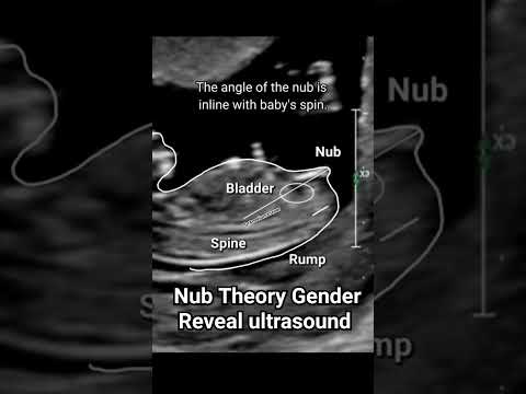 boy or girl? nub theory Gender Reveal ultrasound scan