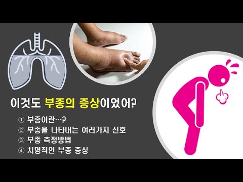 부종 (1) : 이것도 부종의 증상이었어 ? #부종증상 #부종원인 #부종이유 #부종측정