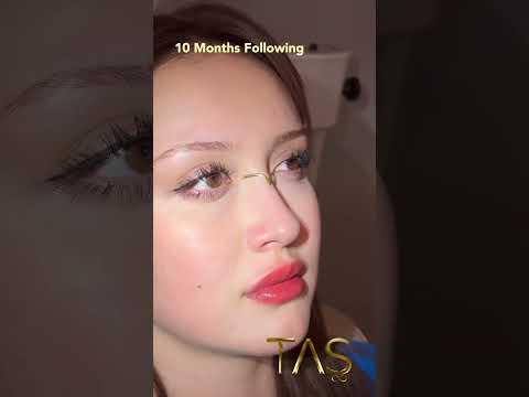 Transformative Rhinoplasty Journey: Experience the mastery of Dr. Suleyman Tas