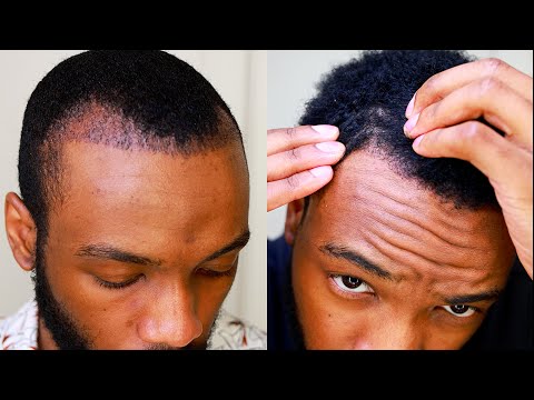 Hair Transplant Week 31