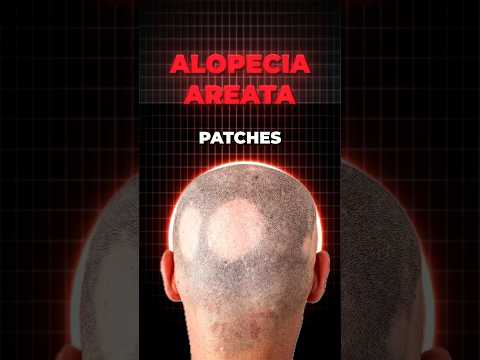 What is Alopecia Areata?