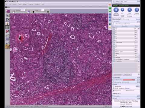 Medical School Pathology, 2013 Season, Session #10: Immune Disorders II