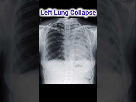 Left Lung Collapse