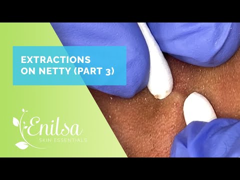 More Blackhead Extractions on Netty - Third Treatment