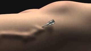 No - Knife Endovenous Laser - Animation of Scarless Varicose Vein Treatment