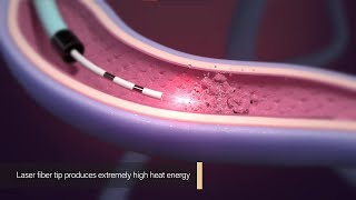 Endovenous Laser Ablation - Medical Animation