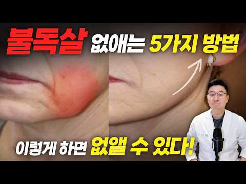 Afraid of Surgery for Sagging Jowls or Marionette Lines? Watch This Now!