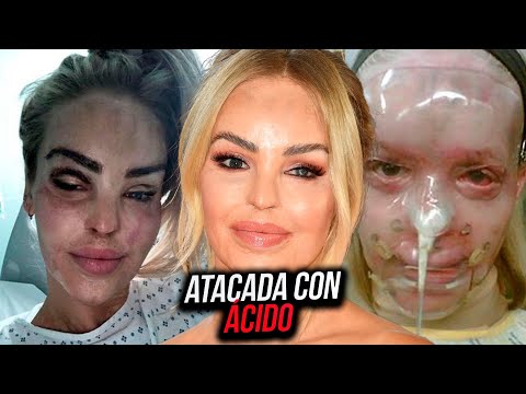 Era MODELO hasta que un LOCO le hizo algo TERRIBLE - Katie Piper