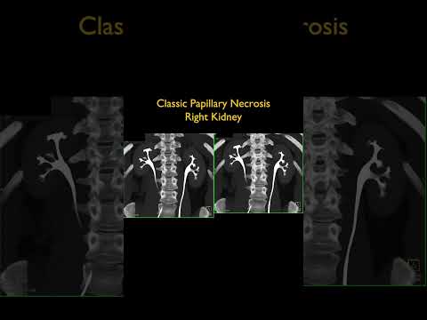 Classic Papillary Necrosis Right Kidney