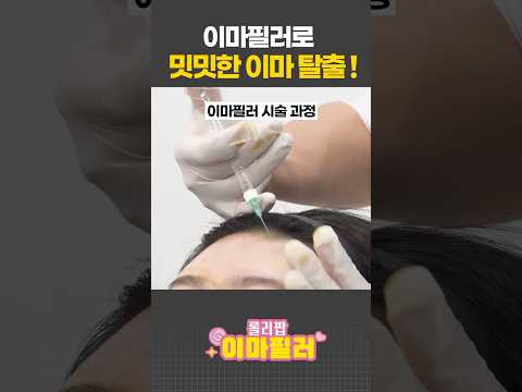 입이 쩍 벌어지는 이마필러 전후 차이🫢#피부관리 #이마필러 #shorts