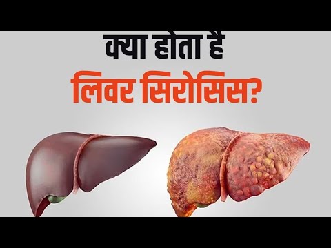 Liver  Cirrhosis|| Signs, Symptoms, Interventions and their Treatment .  #liver #cirrhosis #viral