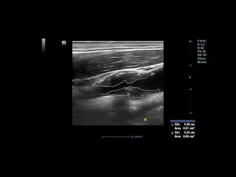 Large type II carotid plaque #shortsvideo