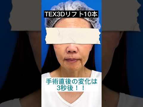 糸リフト（TEX3Dリフト）10本 直後 #shorts