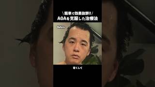 【AGA治療】1年間の経過を全て公開します！！