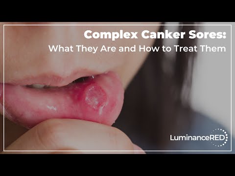 Complex Canker Sores: What They Are and How to Treat Them