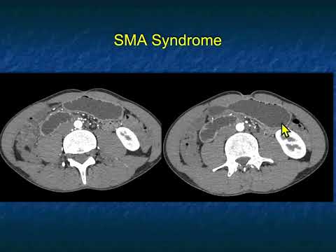 CT of the Abdominal Aorta and Its Branches: Aneurysms, Dissections and Vasculitis - Part 1