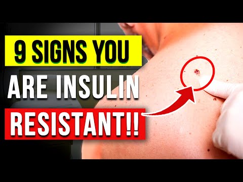 9 Insulin Resistance Symptoms (THIS IS WHY YOU CAN'T LOSE WEIGHT)