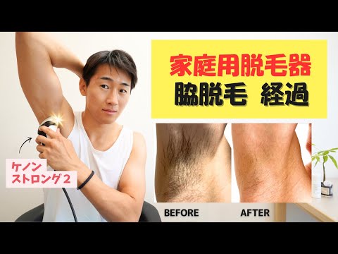 【ケノン】家庭用光脱毛器で脇脱毛したリアルな経過・・・【ストロング2】