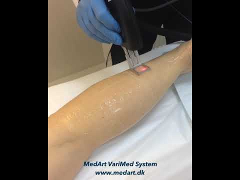 Laser Hair Removal by MedArt VariMed system