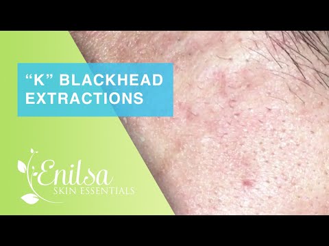 Blackheads Extractions “K’s” 8th Treatment Part 2