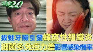 拔蛀牙險引發蜂窩性組織炎 細菌太多、免疫力差影響拔牙感染機率 健康2.0