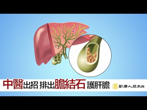 中醫出招！排出『膽結石』疏肝利膽秘笈在這裏  談古論今話中醫488