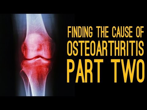 Finding The Cause of Osteoarthritis [Part 2]