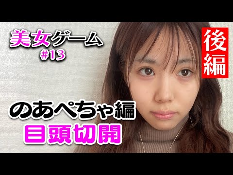 【美女ゲーム #13 】egg  girlsのあぺちゃが目頭切開に挑戦！術後経過大公開♡【美容整形】湘南美容クリニック