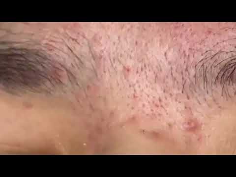 Blackheads & Milia, Big Cystic Acne Blackheads Extraction Whiteheads Removal