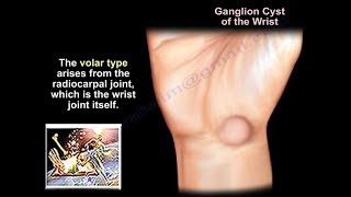 Ganglion Cyst  Wrist - Everything You Need To Know - Dr. Nabil Ebraheim