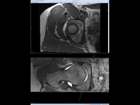 Hip MRI (Approach to MSK MRI Series)