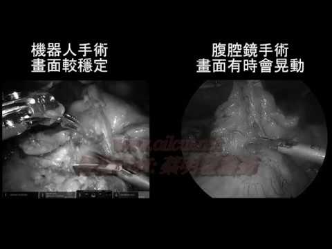 20170130腹腔鏡手術與機器人手術的比較