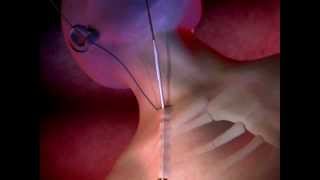 ProGuide™ Chronic Dialysis Catheters Animation