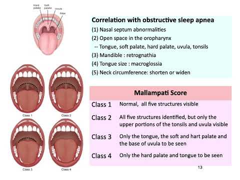 進階臨床醫學20220504 sleep apnea syndrome