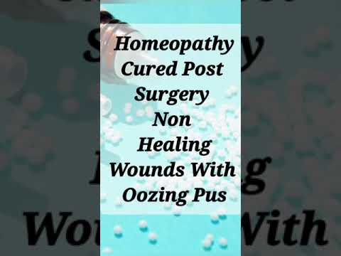 Homeopathy Cured Non healing Post operative wound with oozing Pusby expelling the Dead bone.