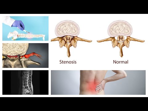 Acute low back pain for 2 weeks after lifting. Doctors discusses when to see doctor | Best Practice